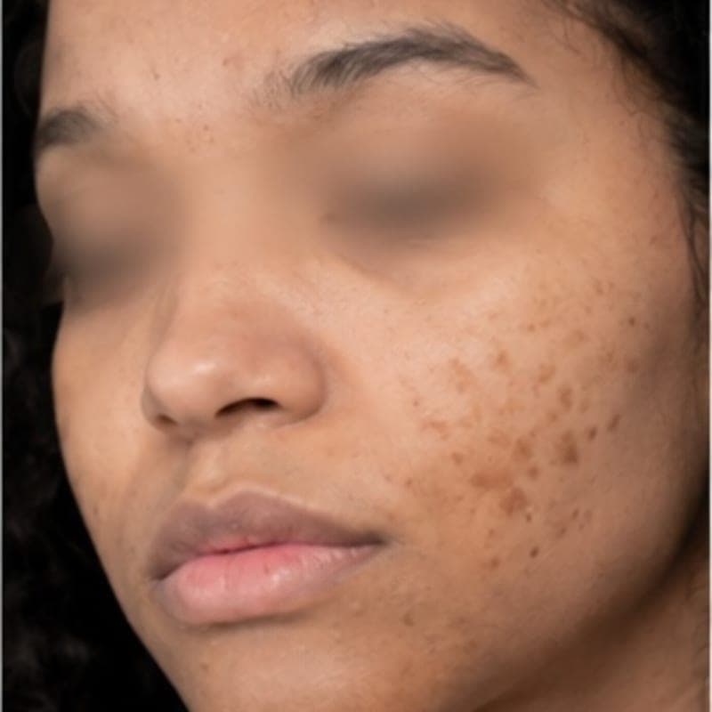 AI illustrative image — Before: Post-acne red marks