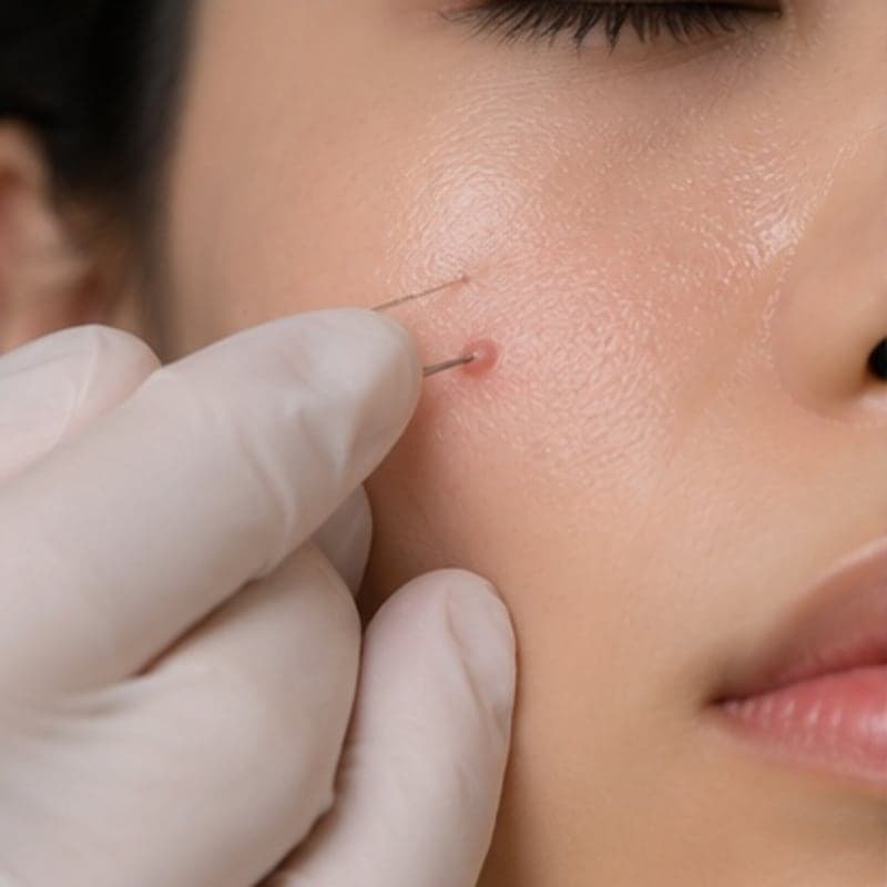 Micro-injection for acne
